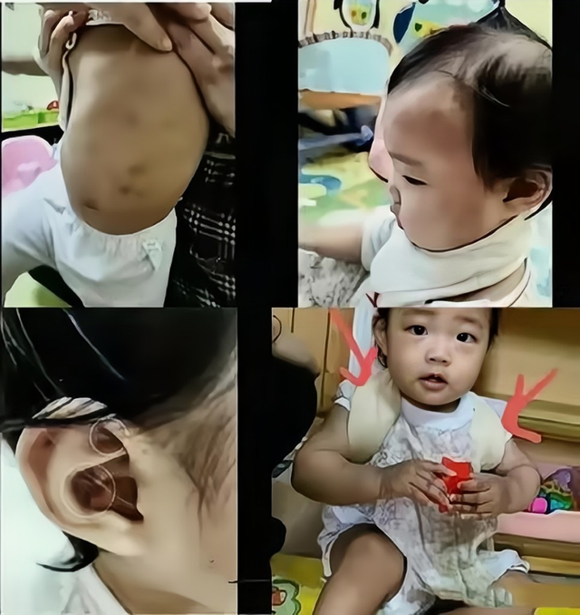 16个月女婴被虐内脏破裂,肠断骨碎,凶手:她自己摔的|郑仁|养母|张夏蓉