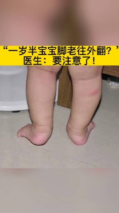 "一岁半宝宝脚老往外翻?" 医生:要注意了!