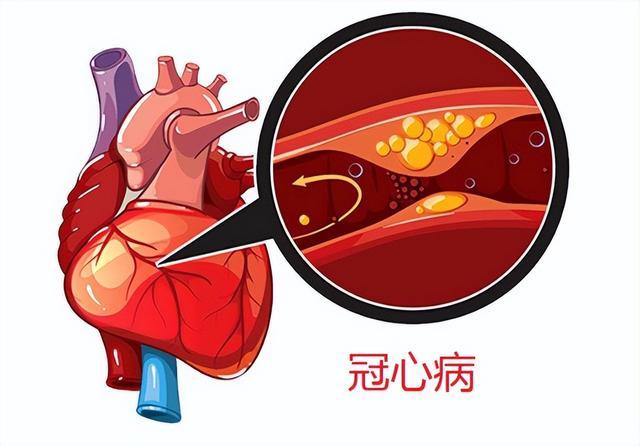 冠心病症状的图片图片