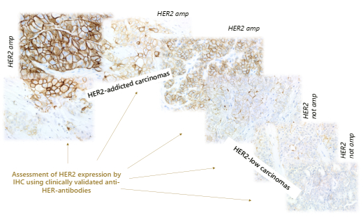 图6. 乳腺癌中HER2过表达的IHC谱
