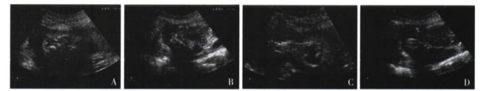 图1 产科多普勒超声