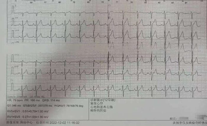 陈子川的心电图显示其窦性心律不齐