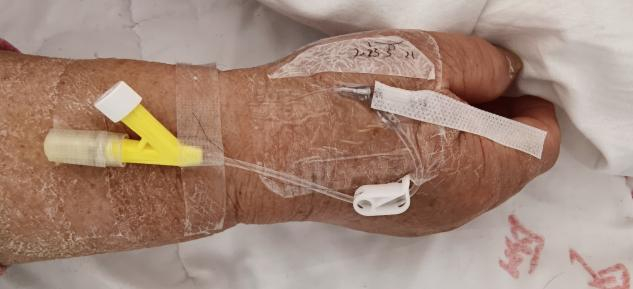 留置针怎么贴膜该怎么拯救你:被“强拉硬拽”的留置针?_新闻资讯_第2张_活检穿刺产品网 留置针怎么贴膜该怎么拯救你:被“强拉硬拽”的留置针?_https://www.jmylbn.com_新闻资讯_第2张