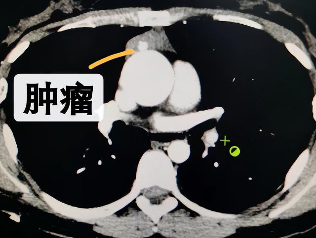 剑突下切口胸腔镜完整切除胸腺瘤,患者体表只有一个“钥匙孔”!|肿瘤|手术|胸部|马忠厦|肿瘤外科_新浪新闻