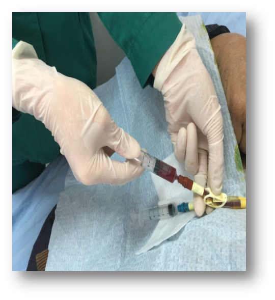 血液透析用中心静脉导管的护理