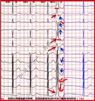 室性早搏伴室房逆传，继发性STT改变
