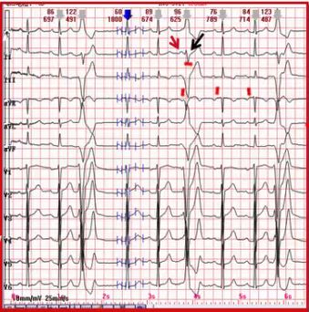 频发单源室性早搏伴房室分离