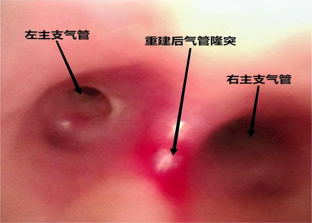 微创技术再突破——郑大三附院完成一例胸腔镜下气管憩室切除,隆突