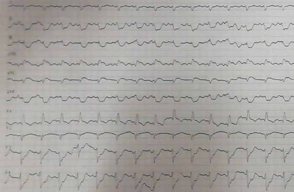 图1 入院后心电图