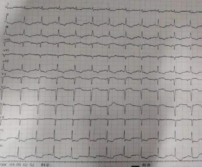 图2 复查心电图