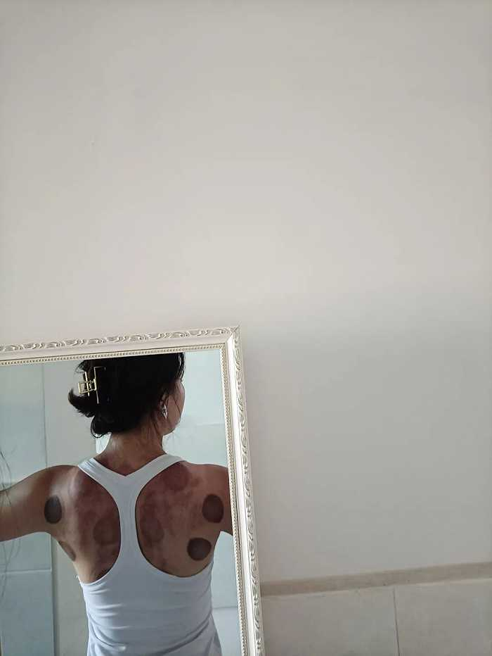 拔罐养生。图 / 受访者提供