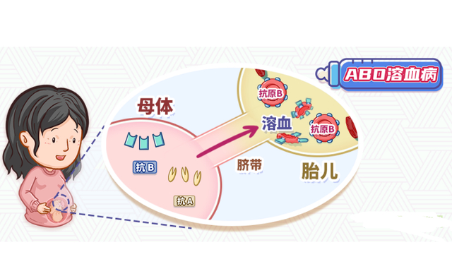 母婴血型不合,导致新生儿溶血病!