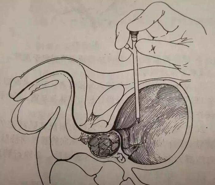 堵尿道的七种方法图片