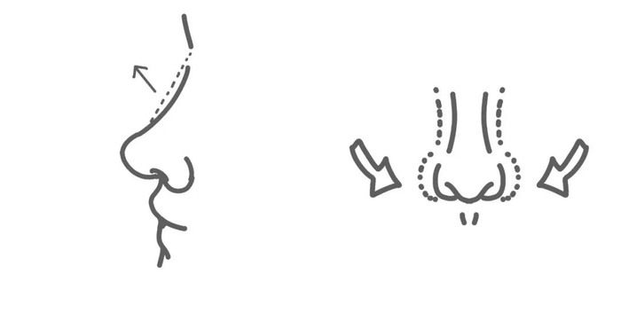 就像隆鼻，即便现在隆鼻正“合适”，过几年孩子鼻腔发育增大，鼻子会有变歪的风险