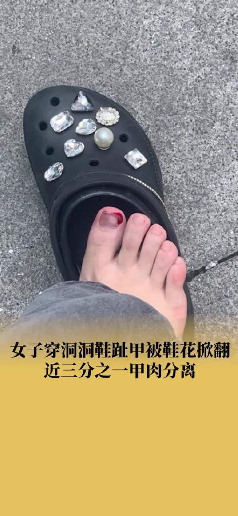 女子穿洞洞鞋脚趾甲被鞋花掀翻大拇指近三分之一甲肉分离