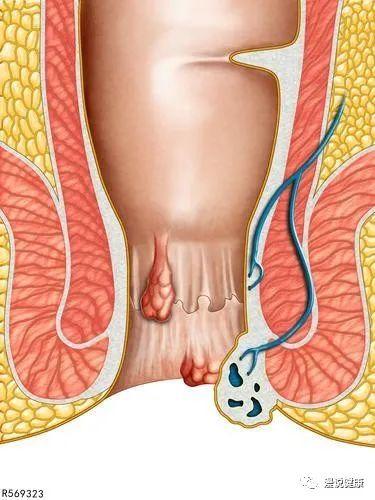 若出现这5个迹象,需留意是否肛门癌来报道