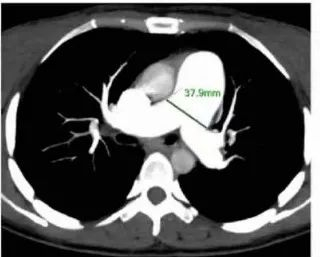 图 肺动脉高压患者CTPA影片
