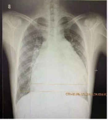 图 肺动脉高压患者胸片