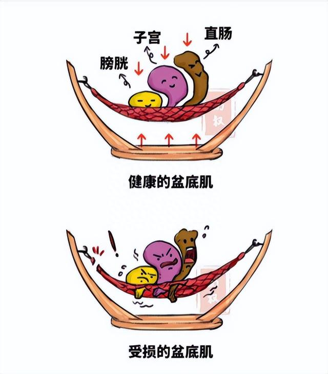 "盆底危机"!调查发现,1/4中老年女性有此问题,其中1/3尿失禁|疾病|阴