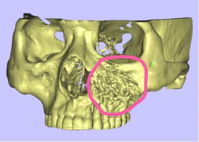 经过一系列检查后,发现他左脸颧骨附近的位置有一个肿瘤.