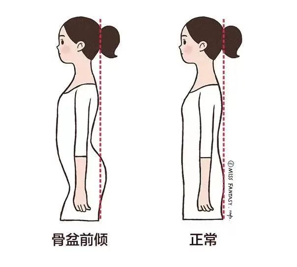 骨盆前倾(左)也是很常见的体态问题,我很早之前有专门分享过,如果你不