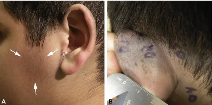 宝宝身上的青斑都是蒙古斑吗?