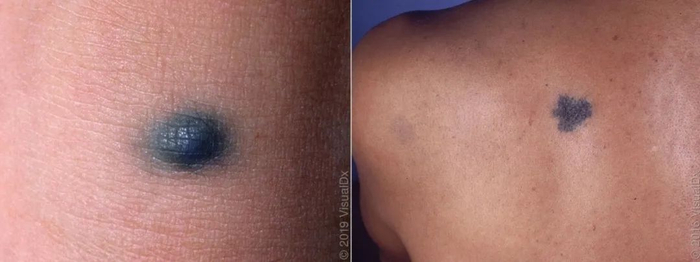 这几种类似的还得重视下|蒙古斑|太田痣|青斑_新浪新闻