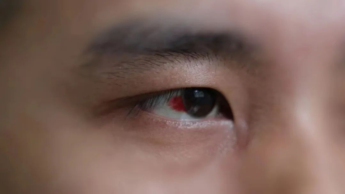 ▲小强眼球上的血块。湖北警方供图