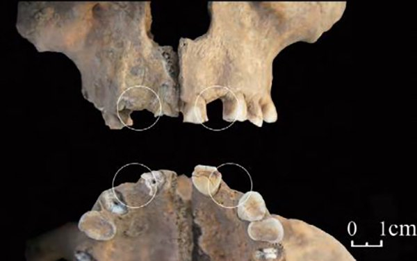 图9 山东后李遗址中北辛文化墓葬的拔牙现象