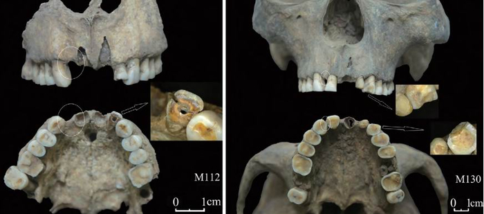 图10 山东焦家遗址中两例未能成功去除左侧上颌侧门齿的个体