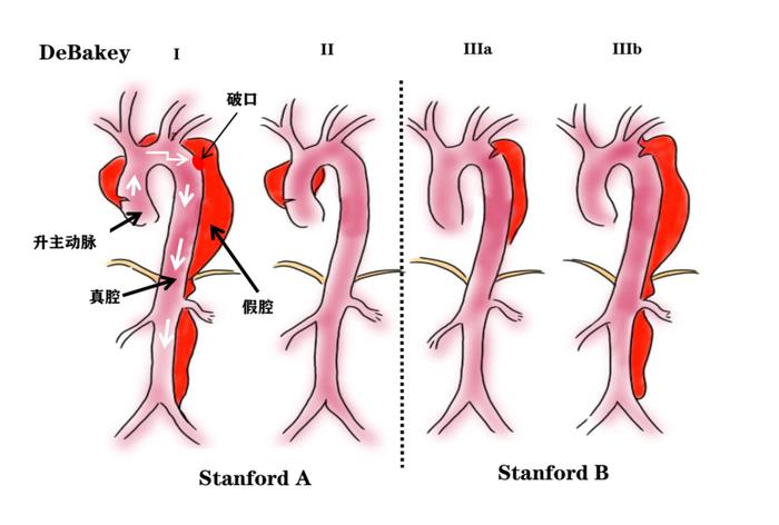 主动脉夹层stanford图片