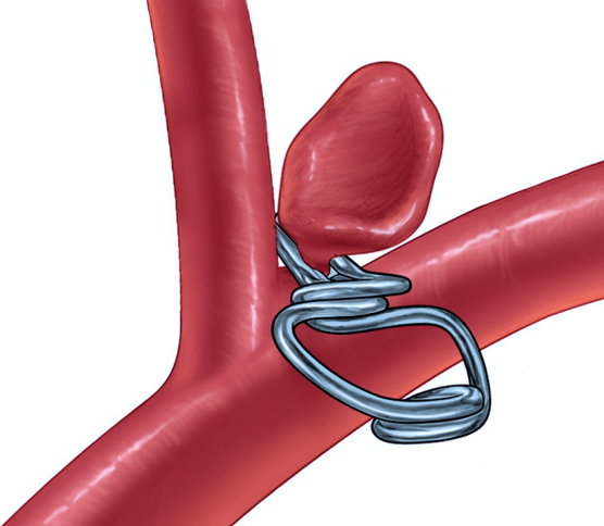 开颅手术直接夹闭