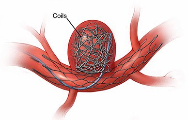 血管内介入栓塞