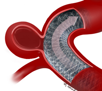 血管内介入栓塞