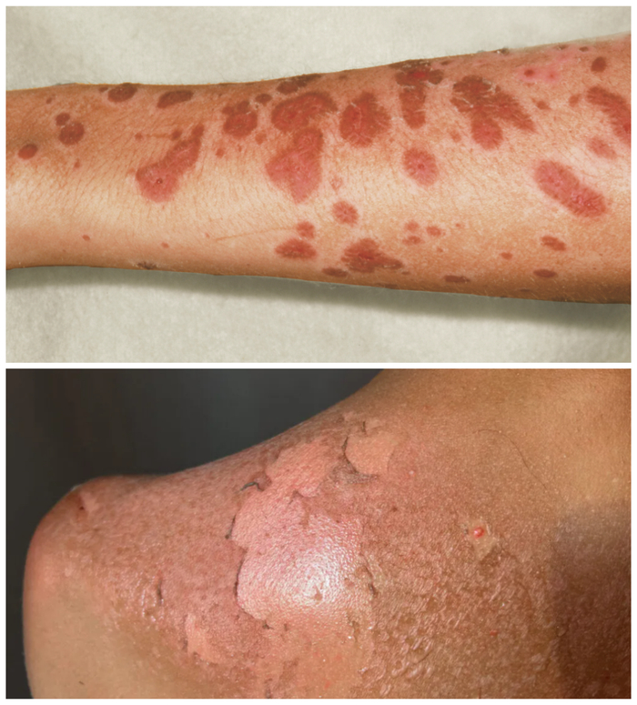 如治疗癫痫的药物卡马西平,过去曾经出现过许多严重药物过敏的案例