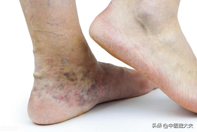 再次提醒:腿上有这种"红血丝"的人,可能是身体发出的危险信号