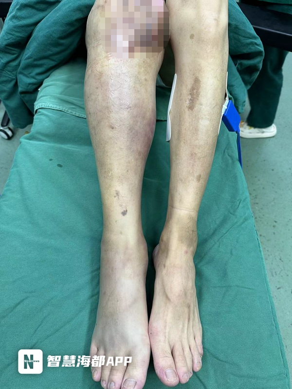 患者右腿明显肿胀