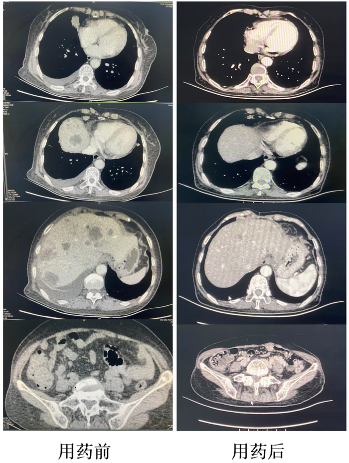 图3. 治疗前后CT对比
