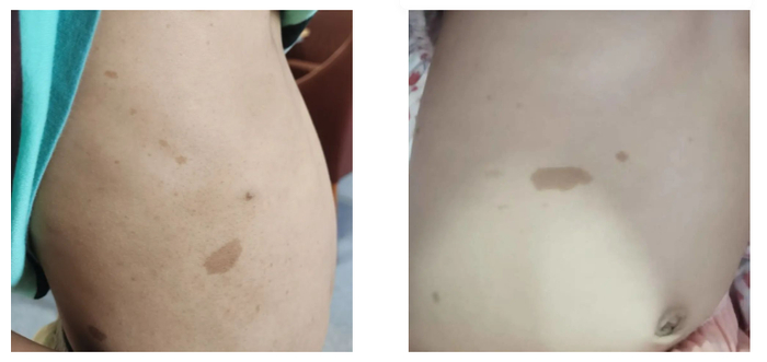 “咖啡斑”状的胎记，浙大二院 图