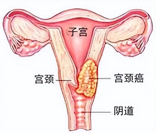 癌症月经图 宫颈癌图片