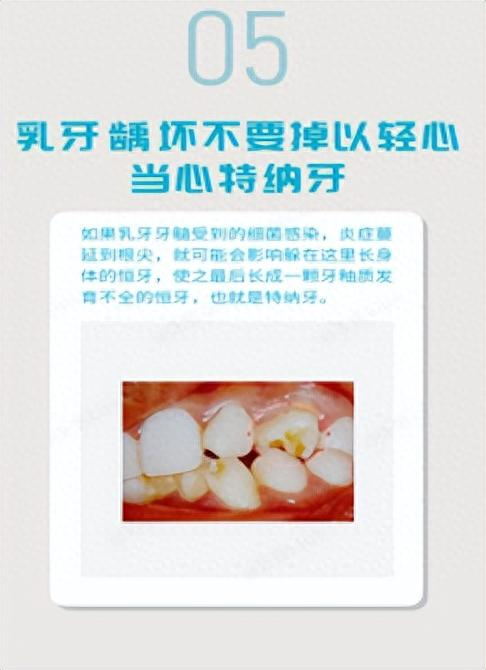 如何保护孩子的乳牙?这份护牙干货快收好|乳牙|乳牙龋_新浪新闻