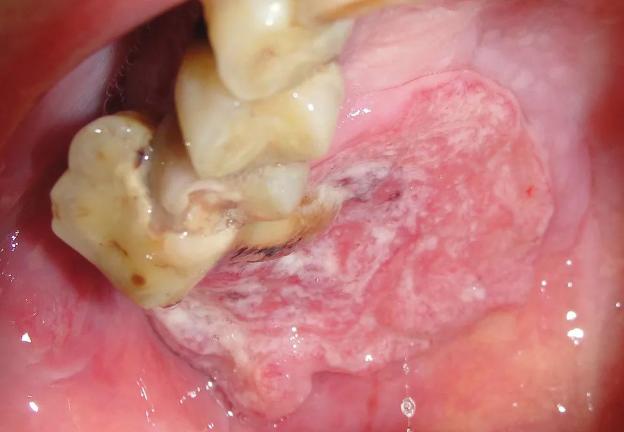 恶性口腔溃疡图片