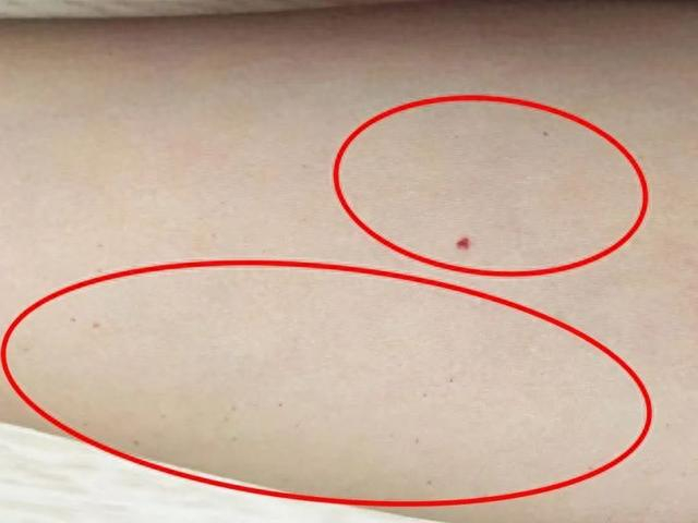 皮肤上长的这种"小红点",当心是肝癌前兆!|肝癌|赵薇_新浪新闻