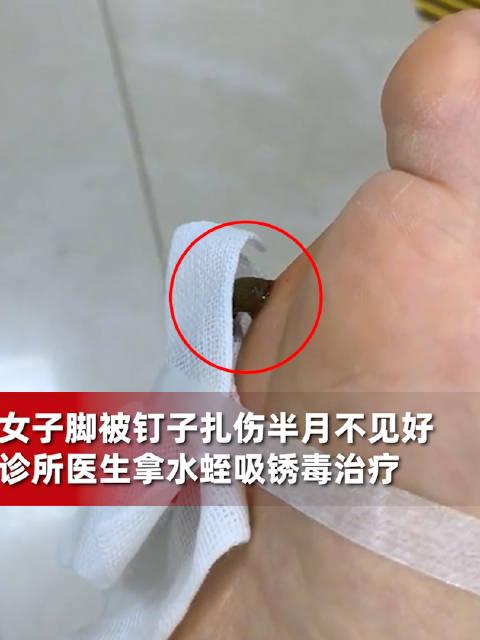 女子腳被釘子扎傷醫生用水蛭吸鏽毒全程不敢看治療效果還挺好