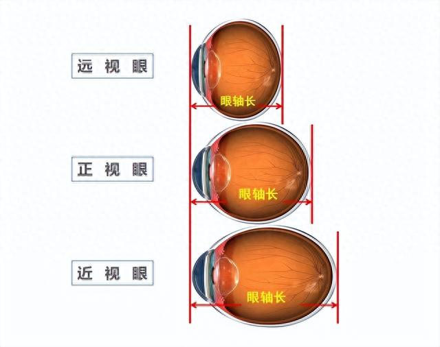 想要孩子不近视,家长需关注远视储备!