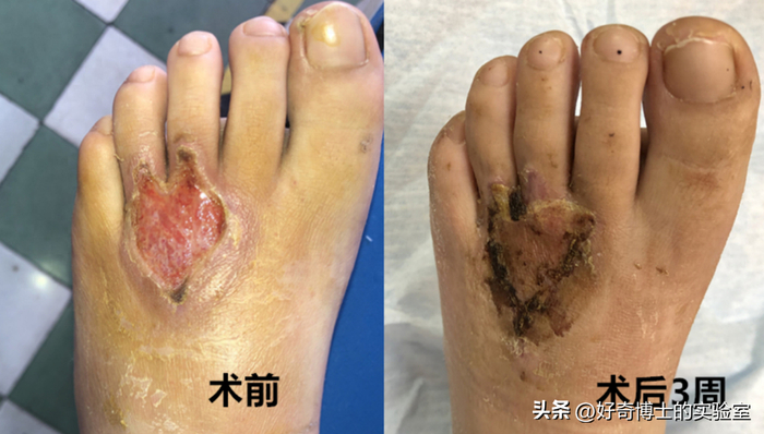 男人刚割掉的包皮千万别丢掉,留着有大用!