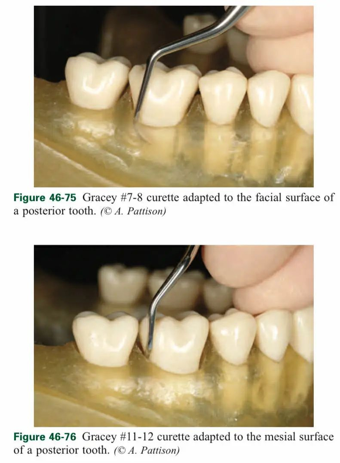 龈下刮治的目的是清除潜藏在牙龈深处的牙结石，