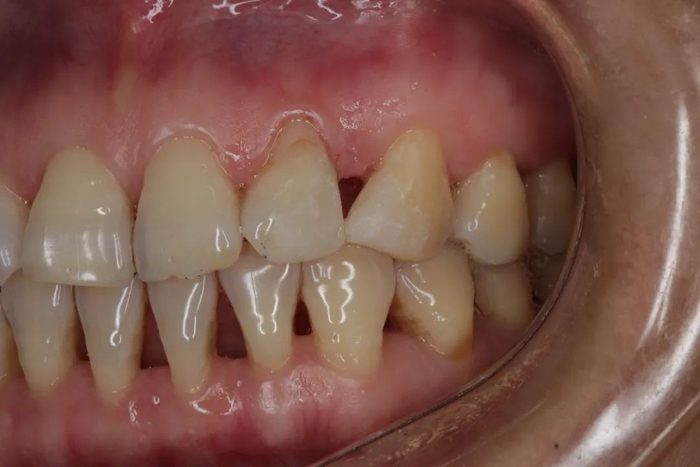 由于牙龈退缩，牙齿之间形成了「黑三角」，此时要治疗和改善已经非常困难，