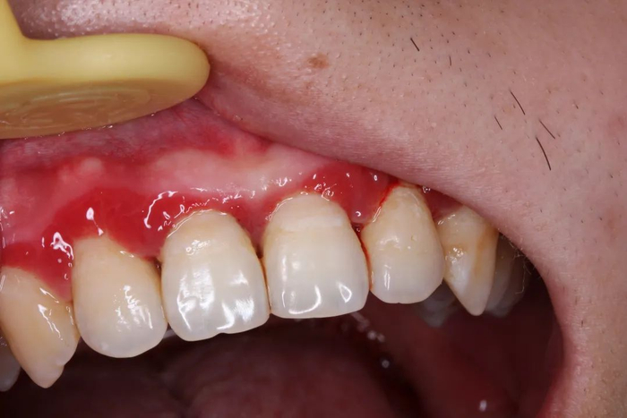刚开始，仅仅是出现牙龈红肿及出血，并不一定导致疼痛，图源：作者提供