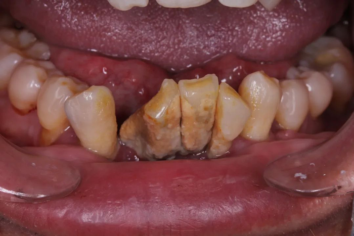 大量牙结石，导致牙齿松动移位，